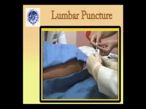 how to locate lumbar puncture site