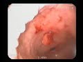gastric polyp