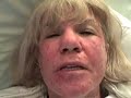 Post Profractional Laser Resurfacing - step 2 Days 1-3