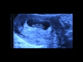 8 week, 4 day ultrasound