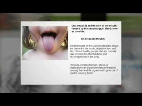 how to treat oral thrush naturally