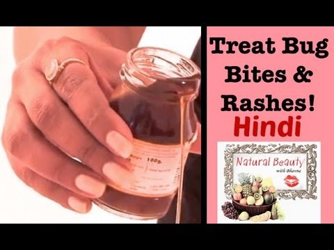how to treat swelling from a mosquito bite