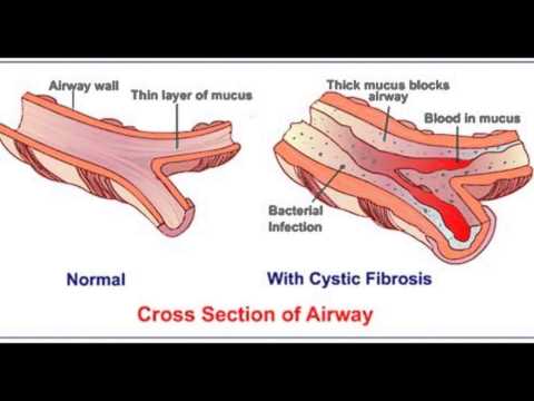 how to cure cystic fibrosis