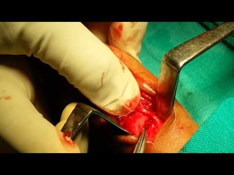 how to treat cmc joint pain