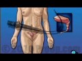 Cystoscopy