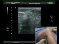 Popliteal Block (Ultrasound guided) - lateral approach