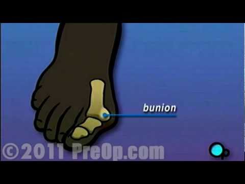 bunion