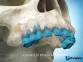 Impaction of Eye-Teeth (Canines) into the Roof of the Mouth