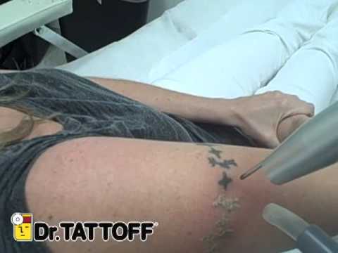 Tags: laser tattoo removal before after dr tattoff