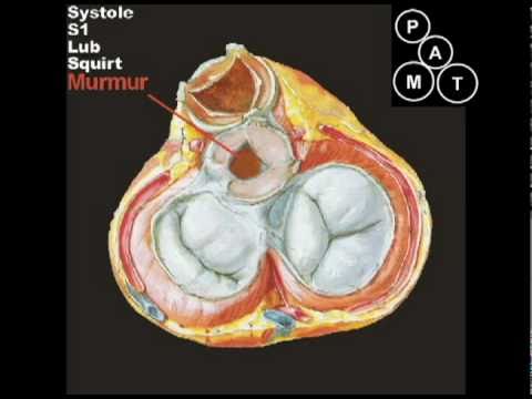 Animated Aortic Stenosis Murmur