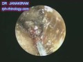 Impacted Wax