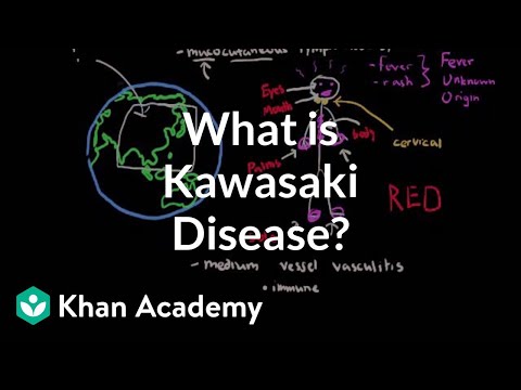 how to cure kawasaki disease