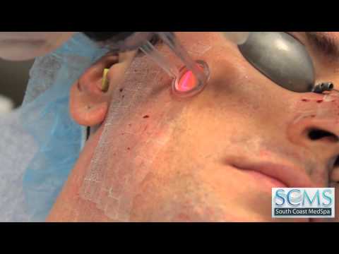 Chino Hills,CA Laser Acne Scar Removal