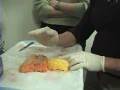 Lipodissolve Video - Injection Lipolysis - Dr. Duncan