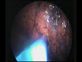 Thoracoscopic lung biopsy