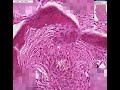 Histopathology Bone--Fibrous dysplasia
