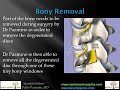 Spondylolisthesis by Pablo Pazmino, MD