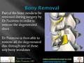 Spondylolisthesis by Pablo Pazmino, MD
