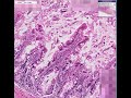 Histopathology Small intestine, ileum--Strongyloides enterit Histopathology Small intestine, ileum--Strongyloides enterit