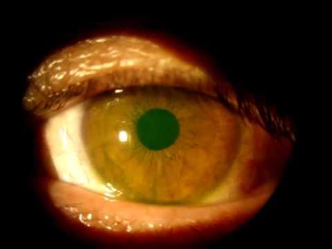 how to fit scleral lenses