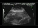 Baby Matzen 4D