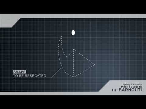 how to perform your own labiaplasty