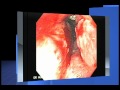 Gastric Cancer