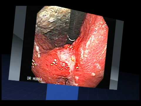 how to treat stage 0 stomach cancer