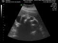 Ultrasound_Short112409.MP4
