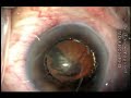Combined IFIS and PXS small Pupil Morcher ring