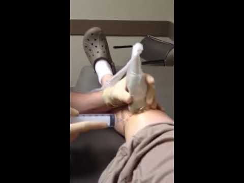 how to drain fluid from knee joints