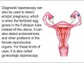 Diagnostic Laparoscopy pt 1 of 2