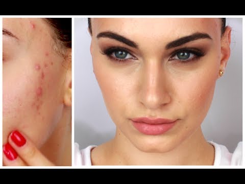 Fake Good Skin ♡ Rosie Huntington-Whitely Inspired + My Acne Treatment | RubyGolani