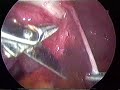 Laparoscopic Adhesiolysis