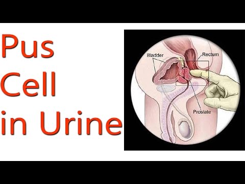 how to cure pyuria