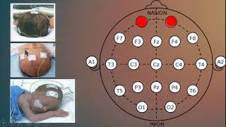 Advanced course - Continuous EEG monitoring -뇌파 혼돈 속의 규칙 김수현