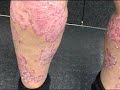 Psoriasis Patient