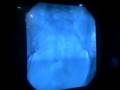 uterine fibroid embolization