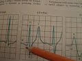 Hyperkalemia Hyperkalemia