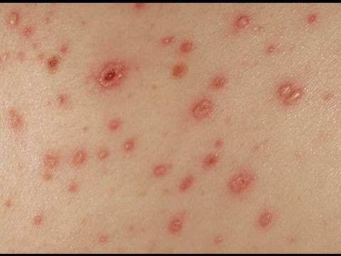 how to whiten chicken pox scars