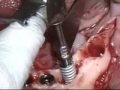 Osseotite� DIEM? With OSSEOTITE NT? By Dr. Alan Meltzer