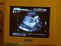 videos de Echographie 6 mois