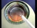 ICL Surgery Animation