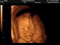 Lucas José - 27 semanas - Eco 3d4d Lucas José - 27 semanas - Eco 3d4d