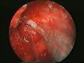 FISTULA DEL LIQUIDO CEFALORRAQUIDEO CIERRE POR TECNICA ENDOS FISTULA DEL LIQUIDO CEFALORRAQUIDEO CIERRE POR TECNICA ENDOS