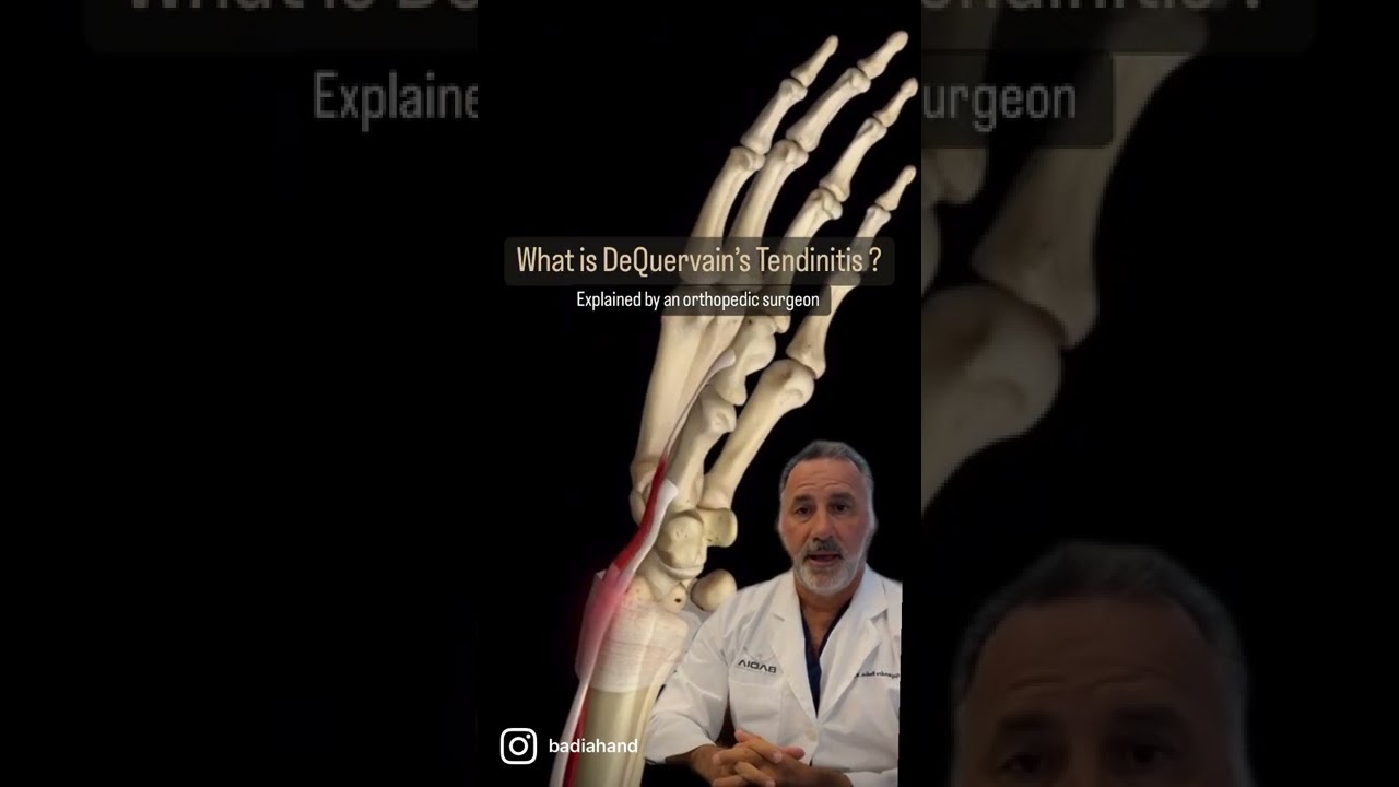 What is #DeQuervains tendinitis? Orthopedic hand surgeon explains using animation