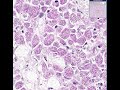 Histopathology Lymph node --Mycobacterium avium-intracellula
