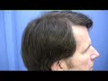 Hair Transplant | \"BW\ Hair Transplant | \"BW\