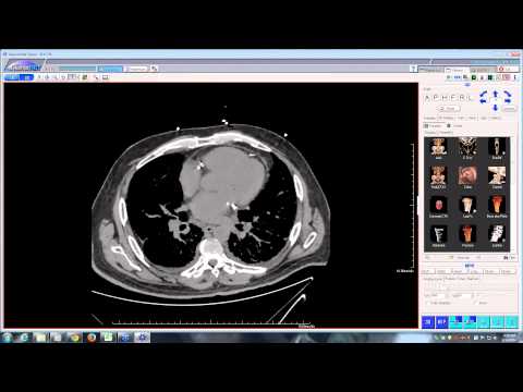 how to drain lungs of pneumonia