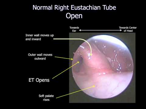 how to relieve eustachian tube blockage